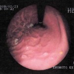 2009年胃カメラ画像-03