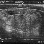 甲状腺腫瘍　エコー検査画像-01
