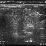 甲状腺腫瘍　エコー検査画像-05